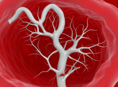 Arteriosklerose