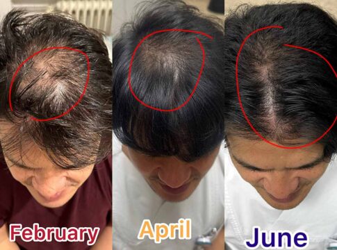 MINOXIDIL spray haar