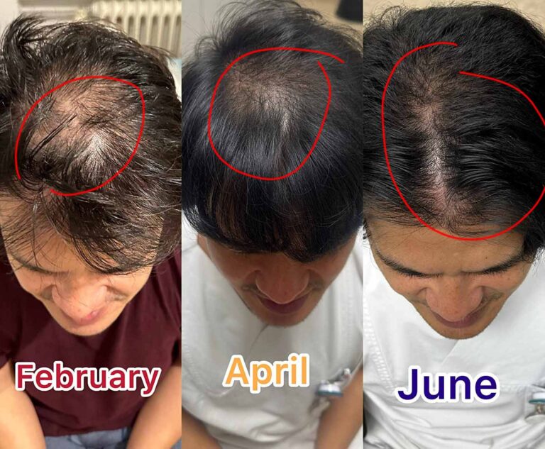 MINOXIDIL spray haar