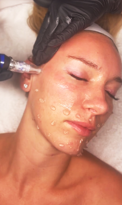 Skinpen Microneedling für zuhause